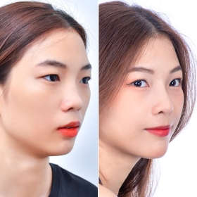 Nâng mũi bằng chỉ Hàn Quốc